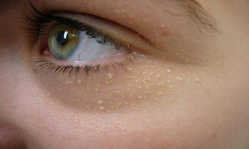 Cách trị mụn gạo quanh mí mắt, trên mặt và dưới da tại nhà