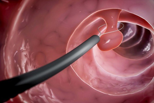 Polyp đại tràng là gì? Triệu chứng và cách chữa polyp đại tràng Polyp đại tràng là gì? Triệu chứng và cách chữa polyp đại tràng