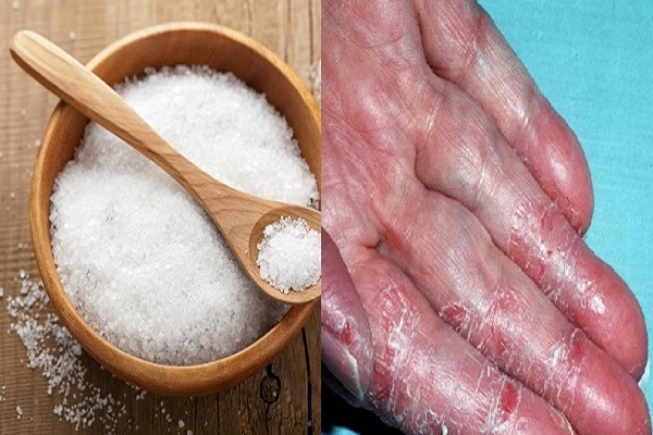 Cách chữa tổ đỉa bằng muối giúp sát trùng diệt khuẩn nhanh khỏi