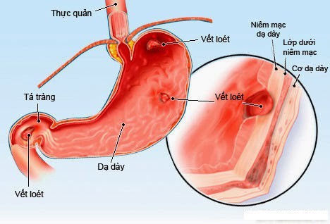 Viêm xung huyết hang môn vị: Kiến thức tổng quan và cách xử lý bệnh Viêm xung huyết hang môn vị: Kiến thức tổng quan và cách xử lý bệnh