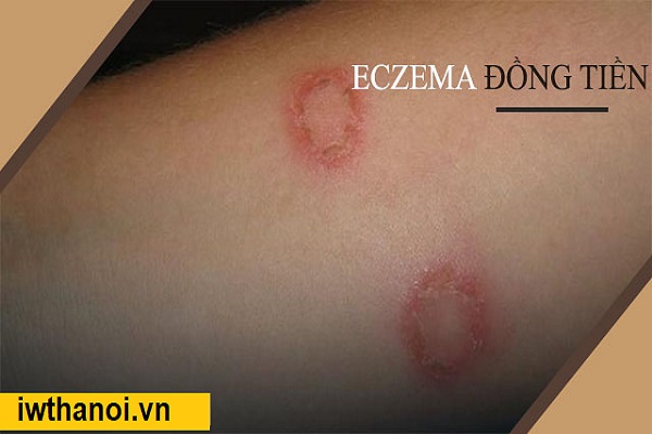 Bệnh eczema là gì? Nguyên nhân, triệu chứng và cách điều trị tốt nhất