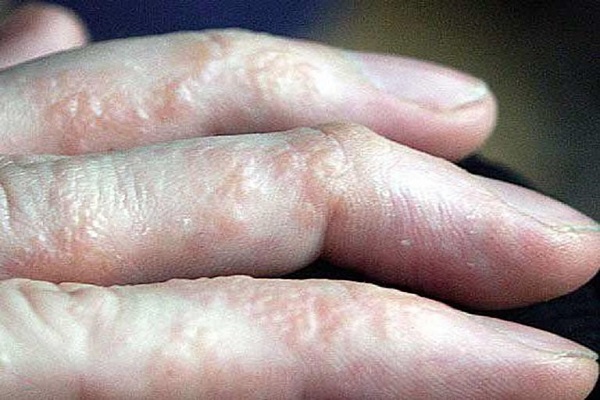 Bệnh tổ đỉa ở tay: Cách nhận biết và thuốc chữa ở bàn tay, ngón tay