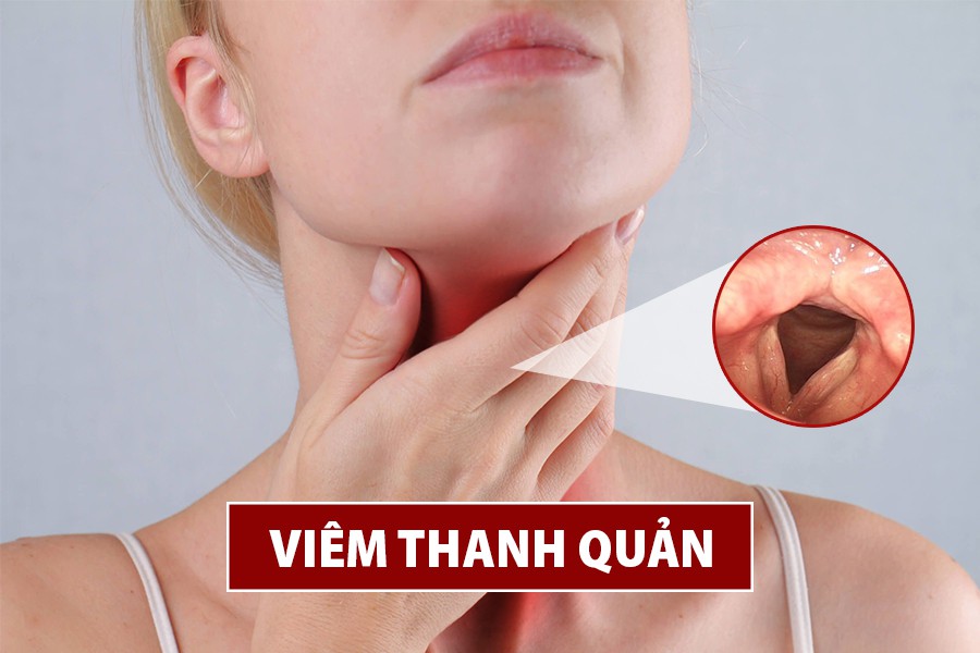 Viêm thanh quản là gì? Triệu chứng, nguyên nhân và cách chữa tại nhà