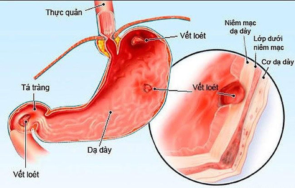 Loét hang vị tiền môn vị là gì và có gây ung thư không? Loét hang vị tiền môn vị là gì và có gây ung thư không?