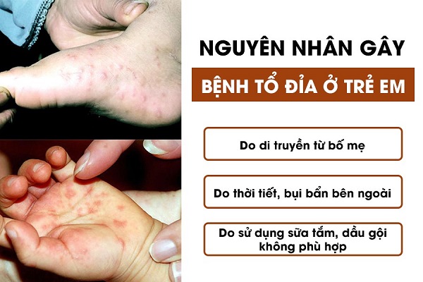 Trẻ em bị bệnh tổ đỉa, nổi mụn nước và cách can thiệp, chăm sóc Trẻ em bị bệnh tổ đỉa, nổi mụn nước và cách can thiệp, chăm sóc