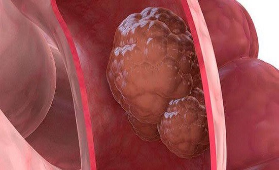 Polyp đại tràng là gì? Triệu chứng và cách chữa polyp đại tràng Polyp đại tràng là gì? Triệu chứng và cách chữa polyp đại tràng