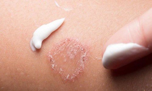 Bệnh hắc lào nấm da mặt: Thông tin bệnh và cách chữa trị an toàn