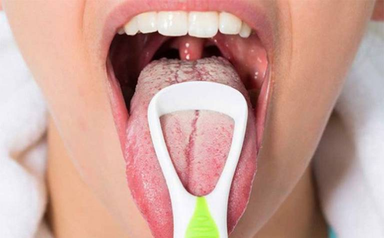 Viêm họng rêu lưỡi trắng trong miệng trông kinh làm thế nào?