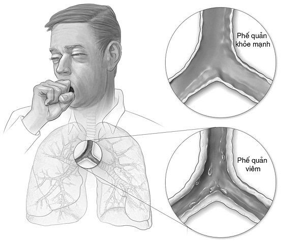 Viêm phế quản co thắt: Phân loại, nhận biết và phác đồ can thiệp