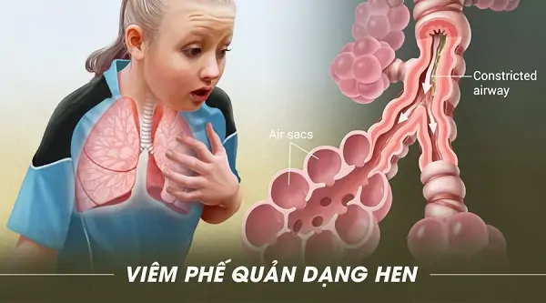 Viêm phế quản dạng hen: Bệnh học, đặc điểm và kinh nghiệm tác động