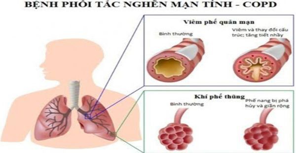 Viêm phổi tắc nghẽn mãn tính: Giai đoạn, độ nguy hiểm và phòng tránh