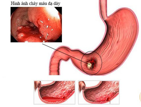 Viêm xung huyết hang môn vị: Kiến thức tổng quan và cách xử lý bệnh Viêm xung huyết hang môn vị: Kiến thức tổng quan và cách xử lý bệnh